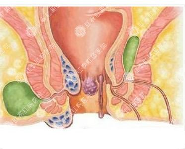 南寧哪個(gè)醫(yī)院可以做肛周膿腫？
