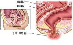 南寧治療脫肛哪家醫(yī)院好？南寧脫肛治療多少錢？